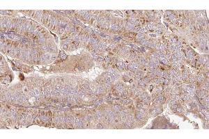 ABIN6267191 at 1/100 staining Human thyroid cancer tissue by IHC-P. (tau antibody  (pSer199))