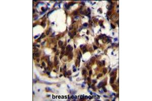 TRADD Antibody immunohistochemistry analysis in formalin fixed and paraffin embedded human breast carcinoma followed by peroxidase conjugation of the secondary antibody and DAB staining.
