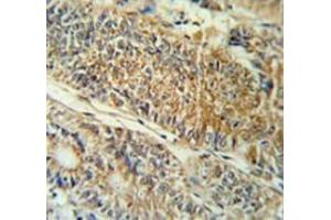 Immunohistochemistry analysis in colon carcinoma (Formalin-fixed, Paraffin-embedded) using PYCR1  Antibody (C-term), followed by peroxidase conjugation of the secondary antibody and DAB staining. (PYCR1 antibody  (C-Term))
