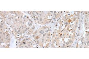 Immunohistochemistry of paraffin-embedded Human esophagus cancer tissue using BORCS8 Polyclonal Antibody at dilution of 1:50(x200)