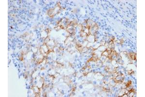 Formalin-fixed, paraffin-embedded human Renal Cell Carcinoma stained with Cadherin 16 Mouse Monoclonal Antibody (CDH16/2448). (Cadherin-16 antibody  (AA 371-507))