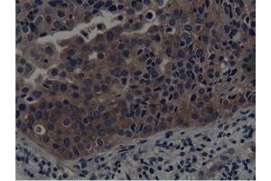 Immunohistochemical staining of paraffin-embedded Carcinoma of Human bladder tissue using anti-SH3GL1 mouse monoclonal antibody. (SH3GL1 antibody)