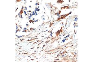 Immunohistochemistry of paraffin-embedded human lung cancer using JNK1/2/3 Rabbit pAb (ABIN7268630) at dilution of 1:100 (40x lens). (MAPK8/9/10 antibody)