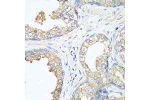 Immunohistochemistry of paraffin-embedded human prostate using CBL antibody (ABIN6131302, ABIN6138002, ABIN6138004 and ABIN6213970) at dilution of 1:200 (40x lens). (CBL antibody  (AA 637-906))