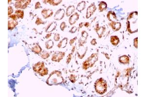 Formalin-fixed, paraffin-embedded human Breast Carcinoma stained with ERCC1 Mouse Monoclonal Antibody (ERCC1/2318). (ERCC1 antibody  (AA 191-281))