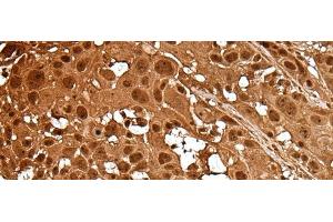 Immunohistochemistry of paraffin-embedded Human esophagus cancer tissue using LAMTOR5 Polyclonal Antibody at dilution of 1:35(x200)