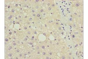 Immunohistochemistry of paraffin-embedded human liver cancer using ABIN7150132 at dilution of 1:100 (DDIT3 antibody  (AA 1-169))