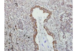 IHC-P Image Immunohistochemical analysis of paraffin-embedded human lung adenocarcinoma, using VAPA, antibody at 1:500 dilution. (VAPA antibody)