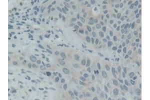 Detection of SNAP25 in Human Lung cancer Tissue using Polyclonal Antibody to Synaptosomal Associated Protein 25 kDa (SNAP25)