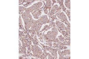 Immunohistochemical analysis of B on paraffin-embedded Human breast carcinoma tissue. (RPL23A antibody  (C-Term))
