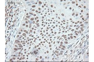 Immunohistochemical staining of paraffin-embedded Adenocarcinoma of colon using anti-Nog (ABIN2452676) mouse monoclonal antibody. (NOG antibody  (AA 28-232))