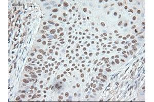 Immunohistochemical staining of paraffin-embedded Adenocarcinoma of colon using anti-Nog (ABIN2452676) mouse monoclonal antibody.