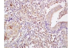 Formalin-fixed and paraffin embedded human lung carcinoma labeled with Anti-MHC Class I Polyclonal Antibody, Unconjugated (ABIN1713559) at 1:200 followed by conjugation to the secondary antibody and DAB staining