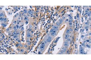 Immunohistochemistry of paraffin-embedded Human gastric cancer using CD54 Polyclonal Antibody at dilution of 1:30 (ICAM1 antibody)