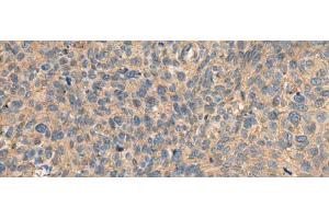 Immunohistochemistry of paraffin-embedded Human cervical cancer tissue using AHNAK Polyclonal Antibody at dilution of 1:50(x200) (AHNAK antibody)