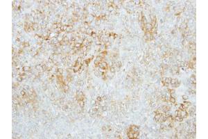 IHC-P Image Immunohistochemical analysis of paraffin-embedded human lung cancer, using GBA, antibody at 1:100 dilution. (GBA antibody  (C-Term))