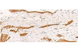 Immunohistochemistry of paraffin-embedded Human esophagus cancer tissue using THNSL1 Polyclonal Antibody at dilution of 1:70(x200) (THNSL1 antibody)