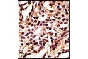 Formalin-fixed and paraffin-embedded human cancer tissue reacted with Autophagy APG12L Antibody (N-term), which was peroxidase-conjugated to the secondary antibody, followed by DAB staining. (ATG12 antibody  (N-Term))