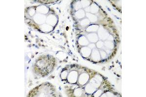 Immunohistochemistry of paraffin-embedded human colon carcinoma using CDC27 antibody at dilution of 1:200 (40x lens). (CDC27 antibody)