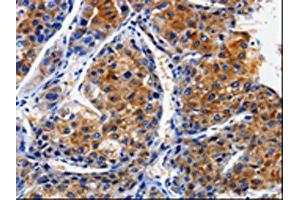 The image on the left is immunohistochemistry of paraffin-embedded Human liver cancer tissue using ABIN7128952(CLCA4 Antibody) at dilution 1/10, on the right is treated with fusion protein.