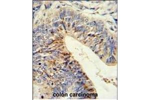 Formalin-fixed and paraffin-embedded human colon carcinoma reacted with ADDEC1 Antibody (N-term), which was peroxidase-conjugated to the secondary antibody, followed by DAB staining. (ADAMDEC1 antibody  (N-Term))