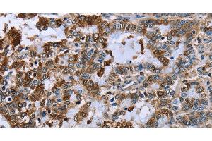 Immunohistochemistry of paraffin-embedded Human liver cancer using IMPDH2 Polyclonal Antibody at dilution of 1:60 (IMPDH2 antibody)