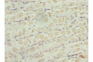 Immunohistochemistry of paraffin-embedded human gastric cancer using ABIN7176235 at dilution of 1:100 (ZNF324 antibody  (AA 1-270))