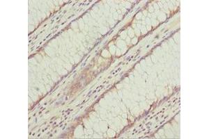 Immunohistochemistry of paraffin-embedded human colon cancer using ABIN7157310 at dilution of 1:100 (KLHL7 antibody  (AA 427-586))