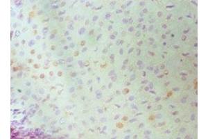 Immunohistochemistry of paraffin-embedded human cervical cancer using ABIN7150339 at dilution of 1:100 (MCM6 antibody  (AA 562-821))