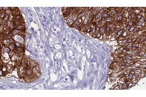 ABIN6276569 at 1/100 staining Human urothelial cancer tissue by IHC-P. (SMPD2 antibody  (Internal Region))