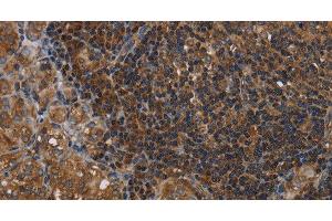 Immunohistochemistry of paraffin-embedded Human thyroid cancer tissue using HOMER2 Polyclonal Antibody at dilution 1:40 (HOMER2 antibody)