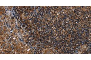 Immunohistochemistry of paraffin-embedded Human thyroid cancer tissue using HOMER2 Polyclonal Antibody at dilution 1:40