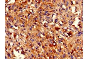 IHC image of ABIN7155391 diluted at 1:800 and staining in paraffin-embedded human melanoma performed on a Leica BondTM system. (HIST1H2BB antibody  (AA 2-126))