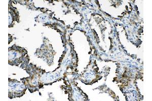 IHC analysis of HSD17B4 using anti- HSD17B4 antibody . (HSD17B4 antibody  (AA 510-736))