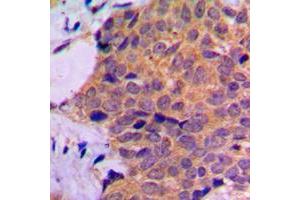 Immunohistochemical analysis of RPL7 staining in human prostate cancer formalin fixed paraffin embedded tissue section. (RPL7 antibody  (C-Term))
