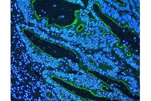 IF analysis of Villi using anti-Villi antibody (ABIN3042343) Villi was detected in paraffin-embedded section of human rectal cancer tissues. (Villin 1 antibody  (C-Term))