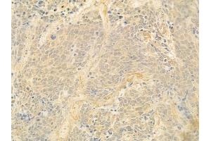 ABIN6262538 and ABIN6278893 at 1/100 staining human small cell lung carcinoma by IHC-P.
