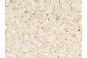 ABIN6266288 and ABIN6276705 at 1/100 staining human astrocytoma by IHC-P. (RENT1/UPF1 antibody  (C-Term))