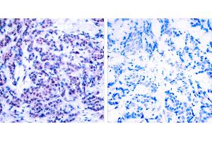 P-Peptide - +Immunohistochemical analysis of paraffin-embedded human breast carcinoma tissue using JunD (phospho- Ser255) antibody. (JunD antibody  (pSer255))