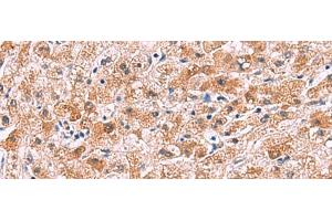 Immunohistochemistry of paraffin-embedded Human liver cancer tissue using IL4R Polyclonal Antibody at dilution of 1:45(x200) (IL4 Receptor antibody)