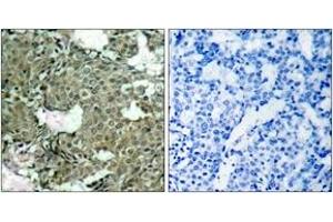 Immunohistochemistry analysis of paraffin-embedded human breast carcinoma, using MEK1/2 (Phospho-Ser221) Antibody. (MEK1/2 antibody  (pSer222))