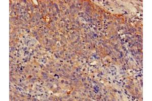 Immunohistochemistry of paraffin-embedded human cervical cancer using ABIN7148581 at dilution of 1:100 (SPRR1A antibody  (AA 8-72))