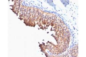 Immunohistochemical staining (Formalin-fixed paraffin-embedded sections) of human bladder carcinoma with KRT10 monoclonal antibody, clone DE-K10 . (Keratin 10 antibody)