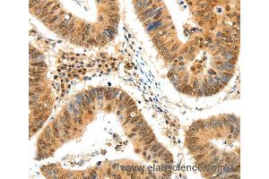 Immunohistochemistry of Human colon cancer using TERF2 Polyclonal Antibody at dilution of 1:50 (TRF2 antibody)