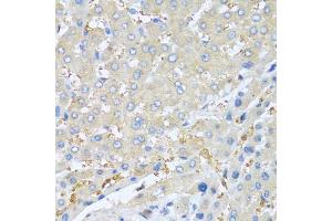 Immunohistochemistry of paraffin-embedded human liver cancer using PPBP antibody (ABIN5970990) at dilution of 1/100 (40x lens).