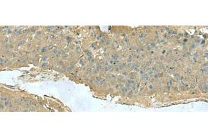 Immunohistochemistry of paraffin-embedded Human liver cancer tissue using KRT36 Polyclonal Antibody at dilution of 1:50(x200) (Keratin 36 antibody)