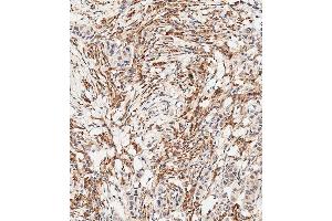 Immunohistochemical analysis of paraffin-embedded Human breast carcinoma tissue using B performed on the Leica® BOND RXm. (FGFR2 antibody  (C-Term))