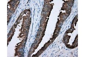 Immunohistochemical staining of paraffin-embedded Carcinoma of liver tissue using anti-PRKAR2A mouse monoclonal antibody. (PRKAR2A antibody)