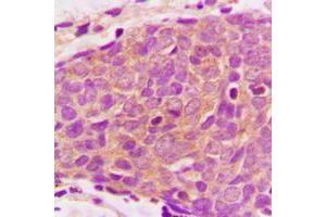 Immunohistochemical analysis of PRAS40 staining in human breast cancer formalin fixed paraffin embedded tissue section. (PRAS40 antibody  (C-Term))