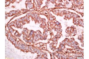 Formalin-fixed and paraffin embedded human lung carcinoma labeled with Anti-Ninjurin 1 Polyclonal Antibody, Unconjugated  at 1:500 followed by conjugation to the secondary antibody and DAB staining (NINJ1 antibody  (AA 1-80))